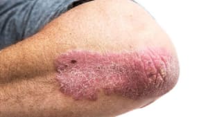 berbagai penyakit kulit psoriasis